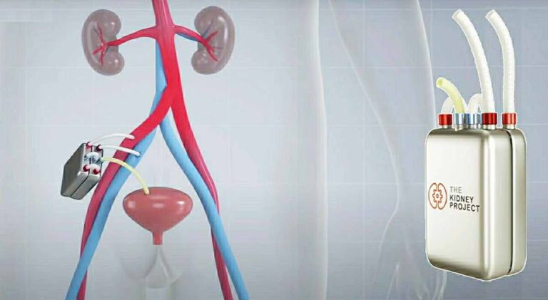 artificial 20kidneys